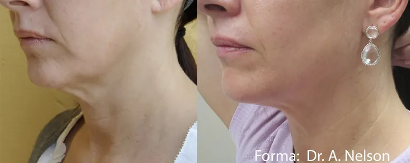 Forma Before After