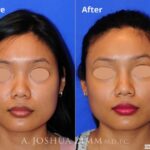 Injectablerhinoplasty20161