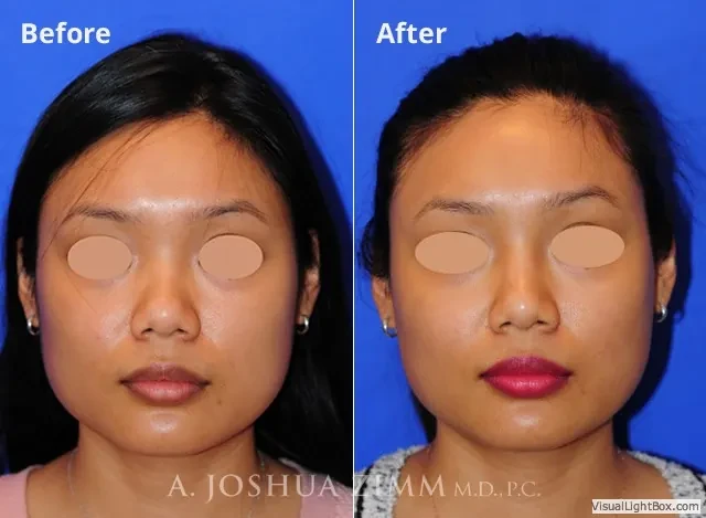 Injectable Rhinoplasty