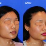 Injectablerhinoplasty20162