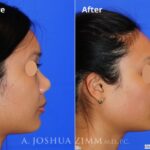Injectablerhinoplasty20163