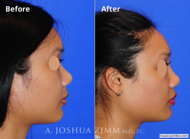 Injectablerhinoplasty20163