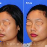 Injectablerhinoplasty20164