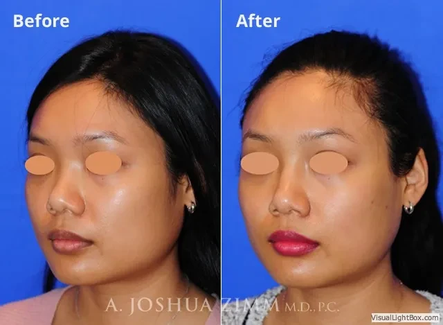 Injectable Rhinoplasty