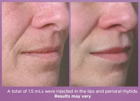 juvederm-volbella