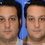 Nasalfracture20161
