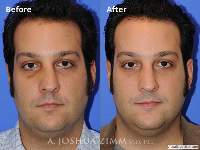Nasalfracture20161