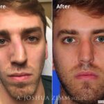 Nasalfracture20171