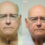 Necklift1 1