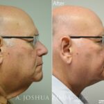 Necklift2 1