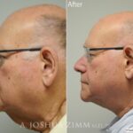 Necklift3 1