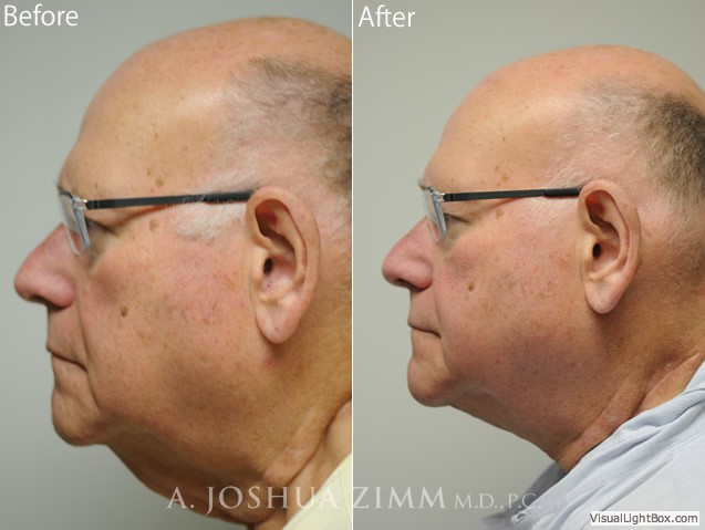Necklift3