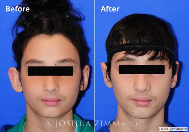 Otoplasty