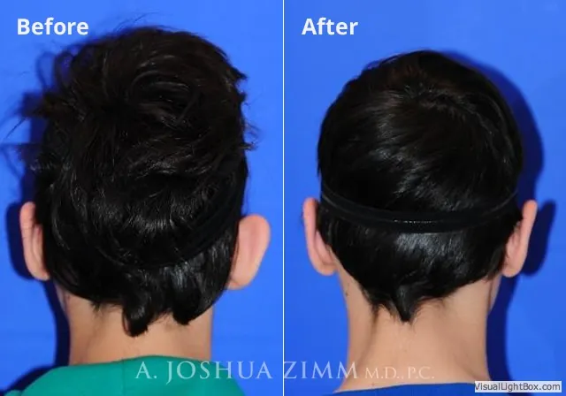 Otoplasty