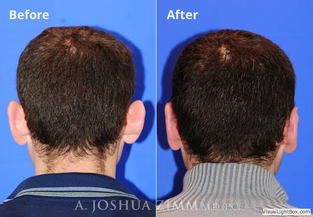 Otoplasty
