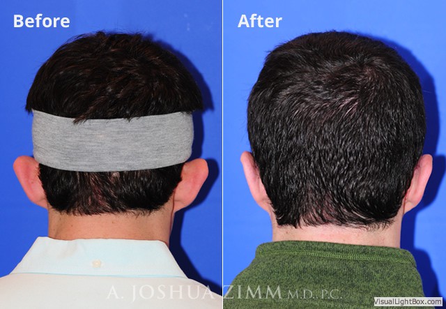 Otoplasty20164