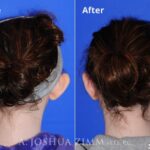 Otoplasty20171