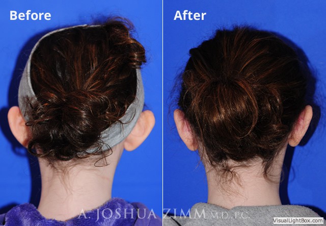 Otoplasty20171