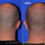 Otoplasty20172