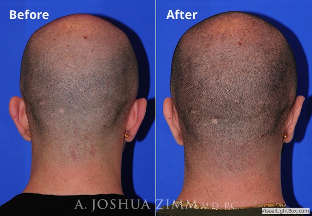 Otoplasty20172