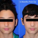 Otoplastyac1