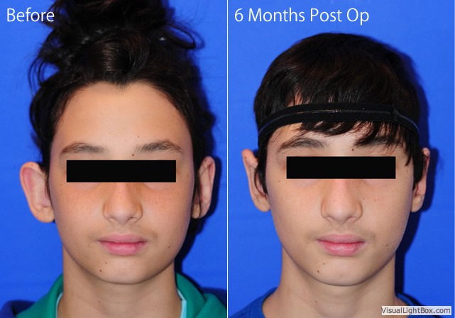 Otoplastyac1