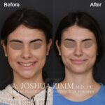 Patient 122 Frontal