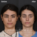 Patient 122 Frontal Non Smiling