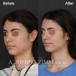 Patient 122 Left Oblique