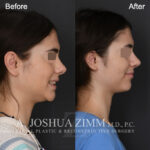 Patient 122 Right Lateral Smiling
