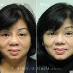 Revisionrhinoplasty20161