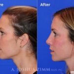 Revisionrhinoplasty201610