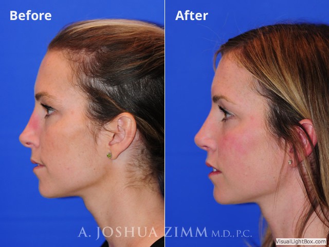 Revisionrhinoplasty201610