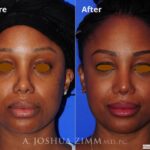 Revisionrhinoplasty201612