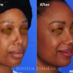 Revisionrhinoplasty201613