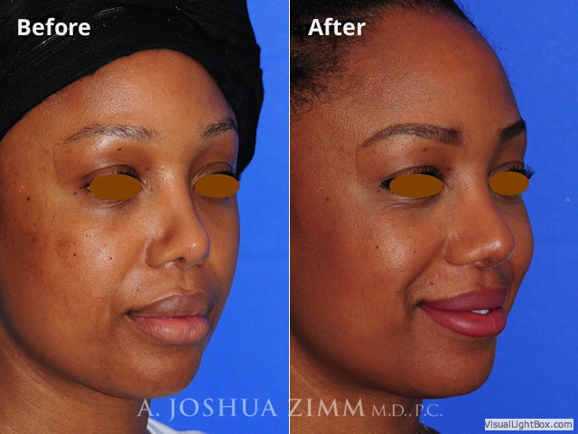 Revisionrhinoplasty201613
