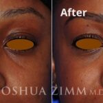 Revisionrhinoplasty201614