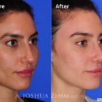 Revisionrhinoplasty201615