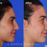 Revisionrhinoplasty201616