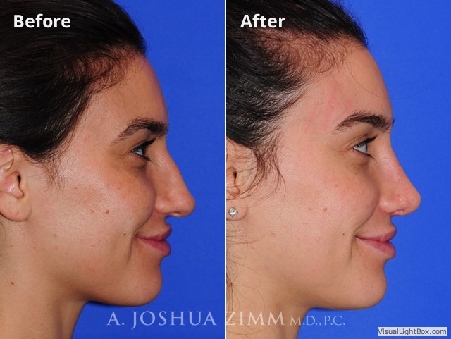 Revisionrhinoplasty201616