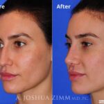 Revisionrhinoplasty201617