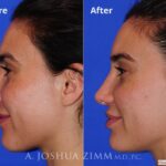 Revisionrhinoplasty201618