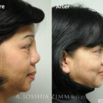 Revisionrhinoplasty20162