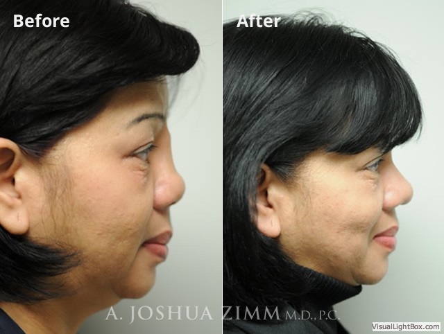 Revisionrhinoplasty20162