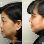 Revisionrhinoplasty20163