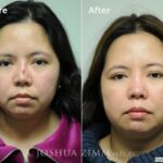 Revisionrhinoplasty20164