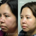 Revisionrhinoplasty20165
