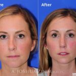 Revisionrhinoplasty20168