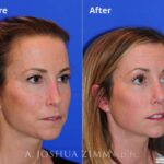 Revisionrhinoplasty20169