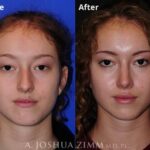 Rhinoplasty 2019 Front 193